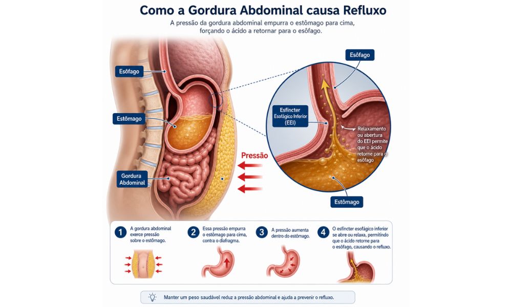 Infográfico médico detalhando como a gordura abdominal exerce pressão sobre o estômago e força a abertura do esfíncter esofágico inferior, causando o refluxo ácido.